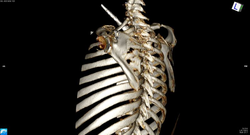 File:Arrow injury in the neck (Radiopaedia 75268-86390 3D 16).jpg