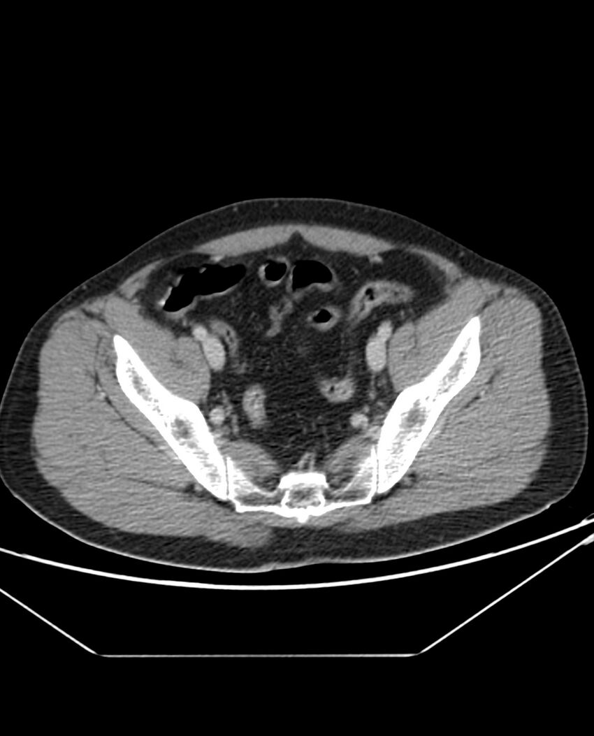 Arterial occlusive mesenteric ischemia (Radiopaedia 84641-100054 A 100).jpg