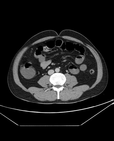 File:Arterial occlusive mesenteric ischemia (Radiopaedia 84641-100054 A 66).jpg