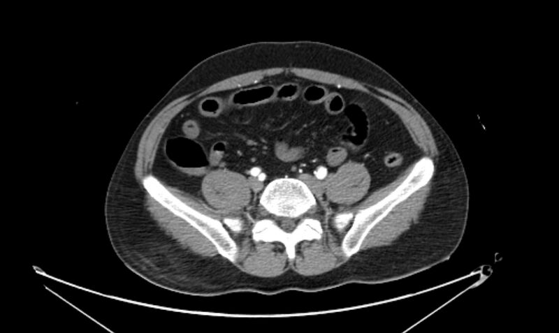 File:Arterial occlusive mesenteric ischemia (Radiopaedia 84641-100060 A 93).jpg