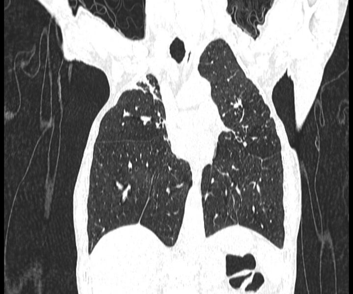 File:Aspergillomas (Radiopaedia 66779-76110 Coronal lung window 10).jpg