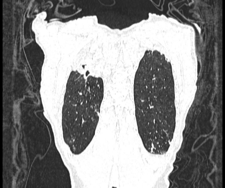 File:Aspergillomas (Radiopaedia 66779-76110 Coronal lung window 20).jpg