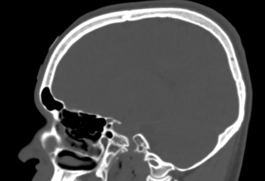Asymptomatic occipital spur (Radiopaedia 87753-104201 Sagittal bone window 120).jpg