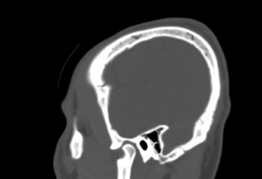 Asymptomatic occipital spur (Radiopaedia 87753-104201 Sagittal bone window 272).jpg