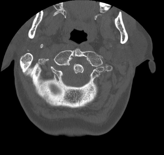 File:Atlanto-occipital assimilation with basilar invagination (Radiopaedia 70122-80188 Axial bone window 17).jpg