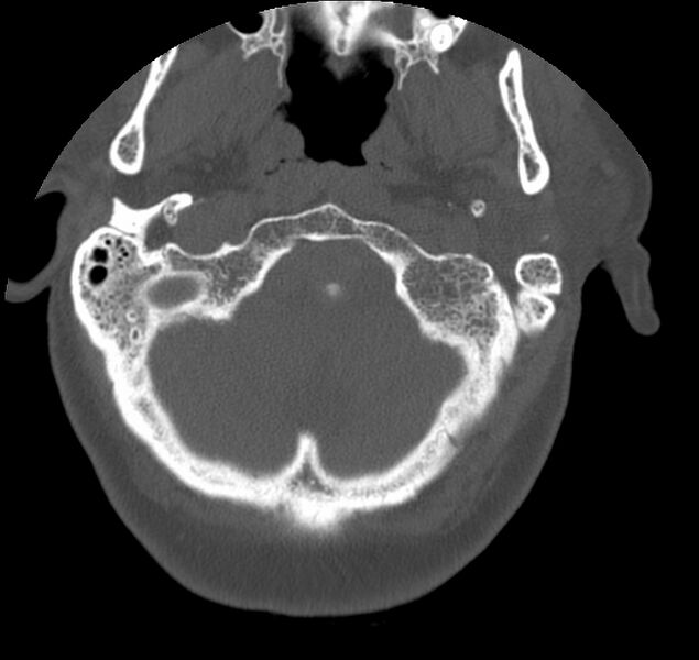 File:Atlanto-occipital assimilation with basilar invagination (Radiopaedia 70122-80188 Axial bone window 8).jpg