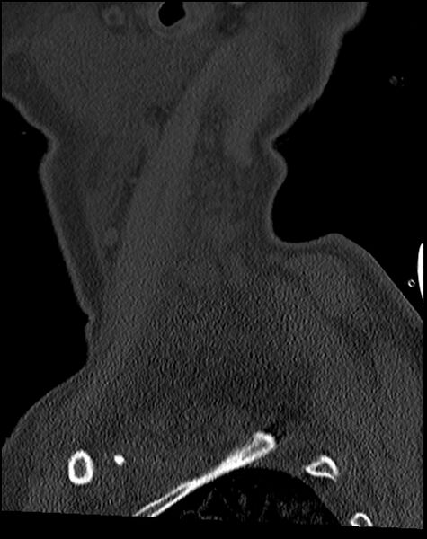 File:Atlanto-occipital dissociation - Traynelis type 1 (Radiopaedia 87570-103948 Sagittal bone window 74).jpg