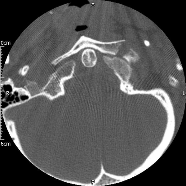 File:Atlas fracture with Currarino type A congenital defect (Radiopaedia 71747-82144 Axial bone window 20).jpg