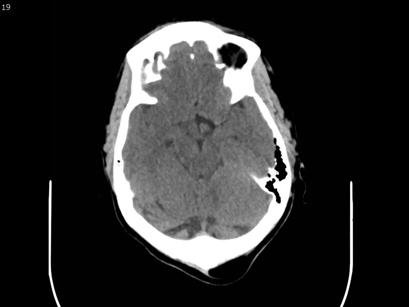File:Atypical meningioma - intraosseous (Radiopaedia 64915-73867 A 19).jpg