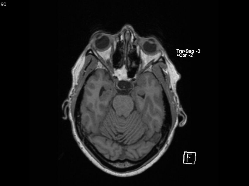 Atypical meningioma - intraosseous (Radiopaedia 64915-74572 Axial T1 90).jpg