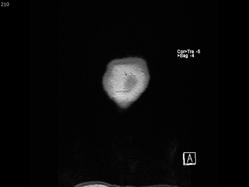 Atypical meningioma - intraosseous (Radiopaedia 64915-74572 Coronal T1 210).jpg