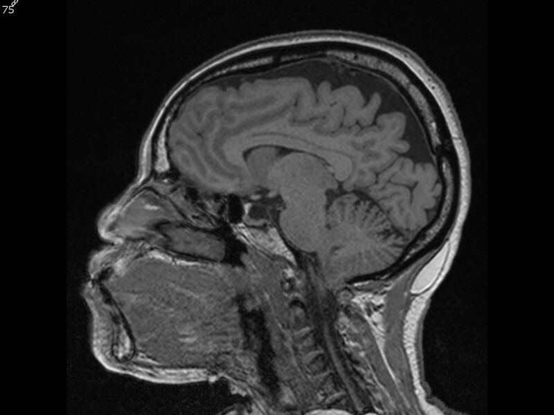 File:Atypical meningioma - intraosseous (Radiopaedia 64915-74572 Sagittal T1 75).jpg