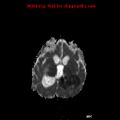 Atypical teratoid rhabdoid tumor (Radiopaedia 10712-11183 Axial ADC 9).jpg