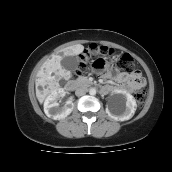 File:Autosomal dominant polycystic kidney disease (Radiopaedia 23061-23093 C 29).jpg