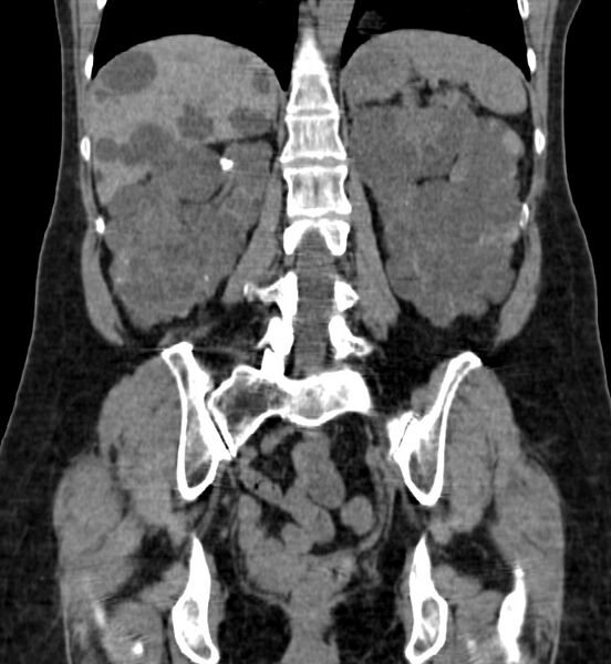 File:Autosomal dominant polycystic kidney disease (Radiopaedia 41918-44922 Coronal non-contrast 33).jpg