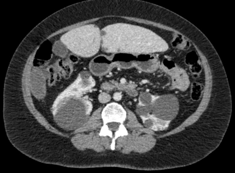 File:Autosomal dominant polycystic kidney disease (Radiopaedia 57124-64017 A 57).jpg