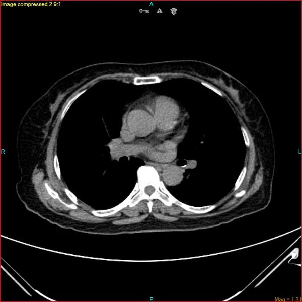 File:Azygos vein aneurysm (Radiopaedia 77824-90130 A 31).jpg