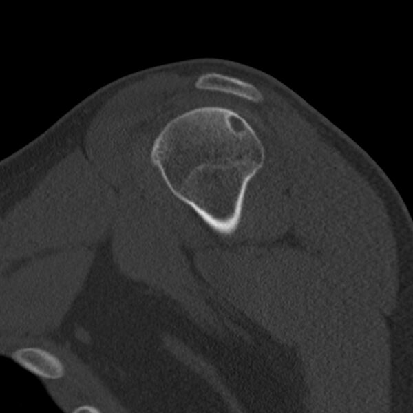 File:Bankart lesion (Radiopaedia 22771-22798 Sagittal bone window 17).jpg