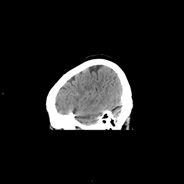 File:Basal ganglia hemorrhage (Radiopaedia 58349-65472 C 10).jpg
