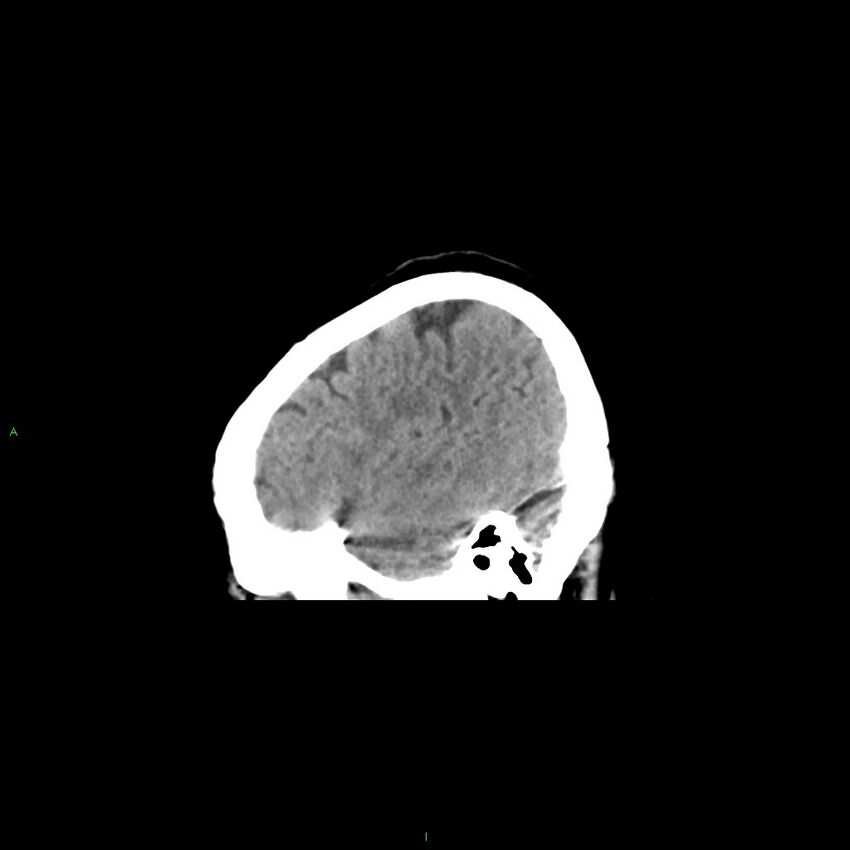 Basal ganglia hemorrhage (Radiopaedia 58349-65472 C 10).jpg