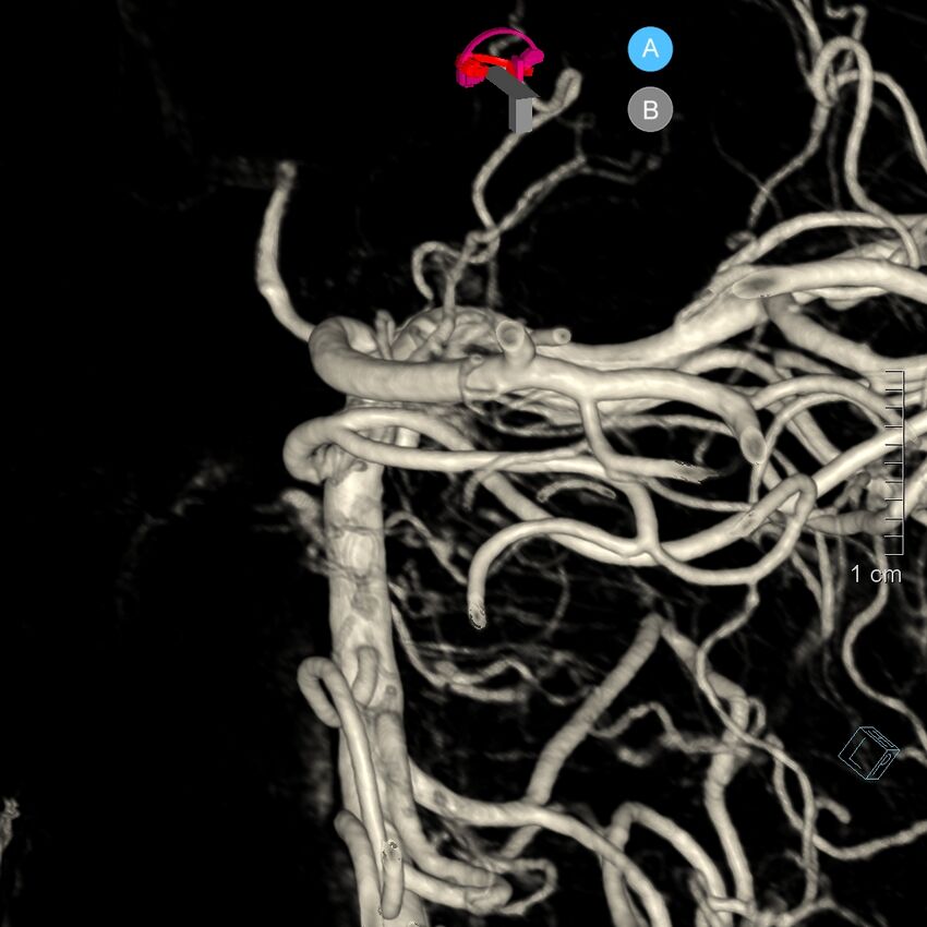 Basilar artery perforator aneurysm (Radiopaedia 82455-97734 3D view left VA 176).jpg