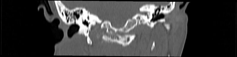 File:Basilar impression (Radiopaedia 52411-58522 Coronal bone window 88).jpg