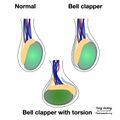 Bell clapper deformity (diagram) (Radiopaedia 86124-102079 H 1).jpeg