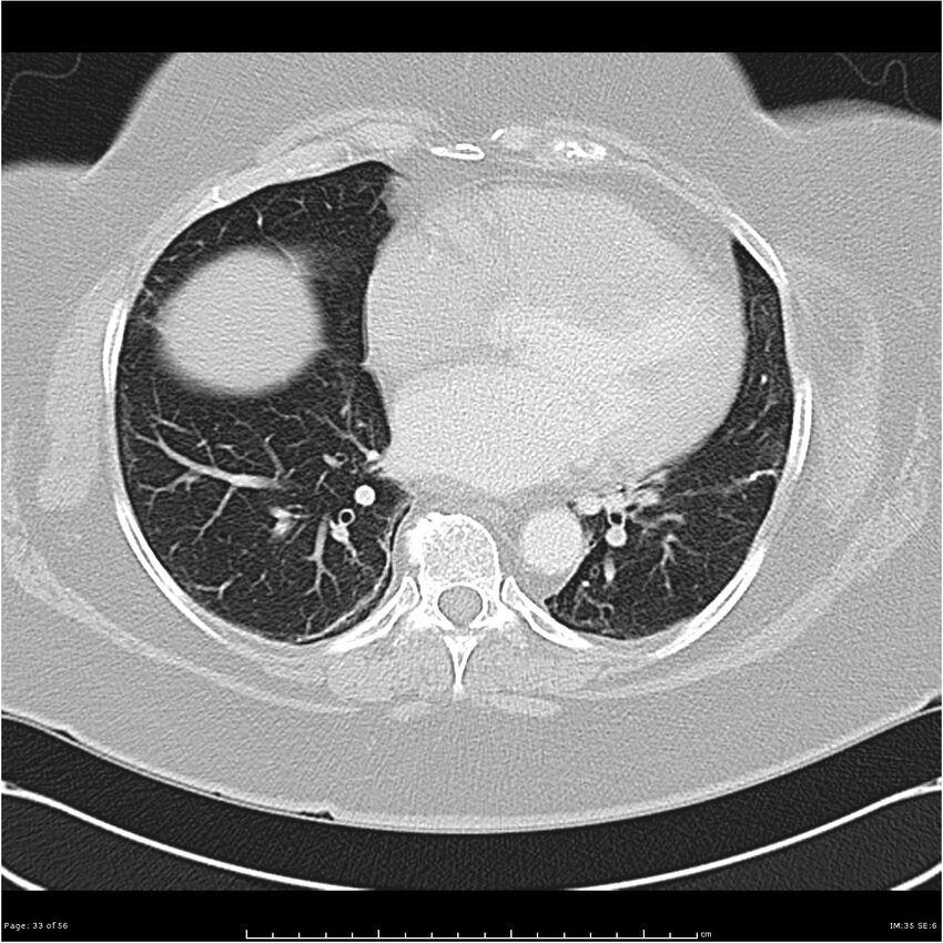 Benign metastasizing leiomyoma (Radiopaedia 26803-26962 Axial lung window 33).jpg