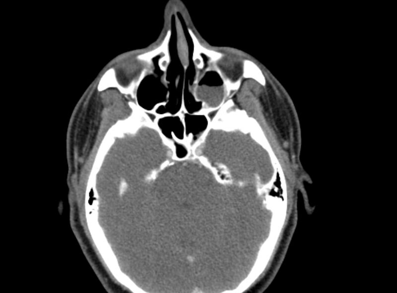 File:Benign mixed salivary tumor of the parotid gland (Radiopaedia 35261-36792 A 5).jpg