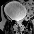 Benign seromucinous cystadenoma of the ovary (Radiopaedia 71065-81300 F 16).jpg