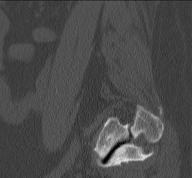 File:Bertolotti syndrome (Radiopaedia 24864-25128 Sagittal bone window 8).jpg