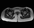 Bicornuate bicollis uterus (Radiopaedia 61626-69616 Axial T2 32).jpg