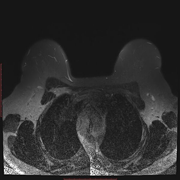 File:Bilateral breast implant rupture (Radiopaedia 24761-25027 T2 fat sat 9).jpg