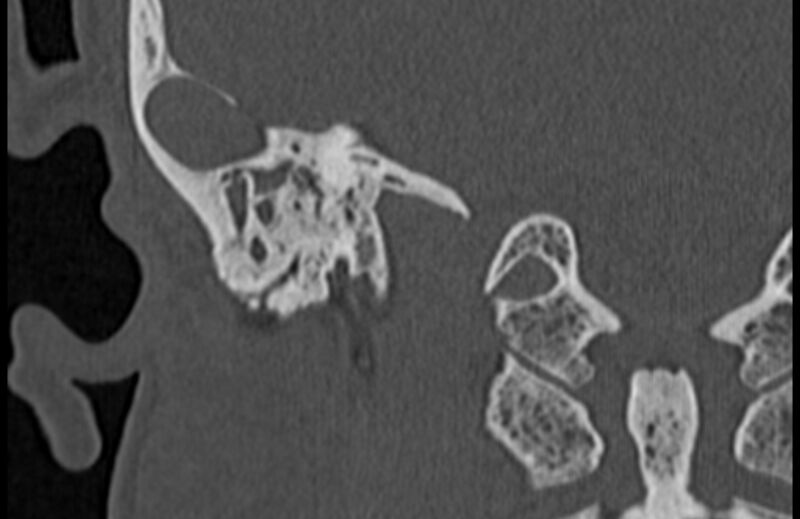 File:Bilateral cholesteatoma (Radiopaedia 54898-61172 Coronal bone window 63).jpg