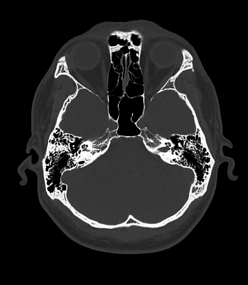 Bilateral medial canal fibrosis (Radiopaedia 85598-101344 Axial bone window 44).jpg