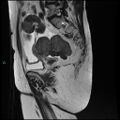 Bilateral ovarian fibroma (Radiopaedia 44568-48293 Sagittal T2 22).jpg