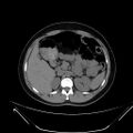 Bilateral ovarian mature cystic teratomas (Radiopaedia 79373-92457 Axial non-contrast 10).jpg