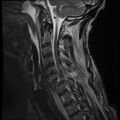 Bilateral perched facets with cord injury (Radiopaedia 45587-49714 Sagittal T2 10).jpg