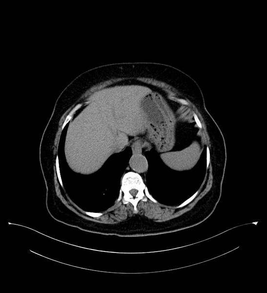 File:Bilateral sporadic synchronous clear cell renal cell carcinoma (Radiopaedia 85035-100575 Axial non-contrast 11).jpg