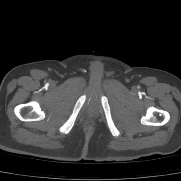 File:Bilateral superficial femoral arterial occlusion (Radiopaedia 25682-25857 A 30).jpg