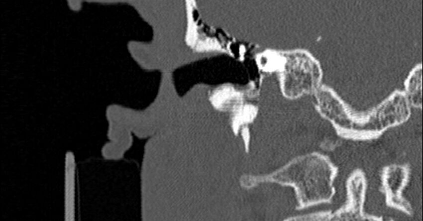 Bilateral temporal bone fractures (Radiopaedia 29482-29970 Coronal non-contrast 92).jpg