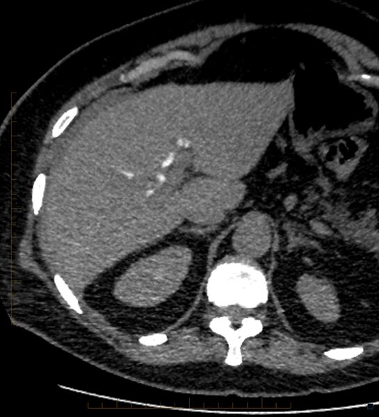 File:Bile leak from accessory duct(s) of Luschka post cholecystectomy (Radiopaedia 40736-43389 A 19).jpg