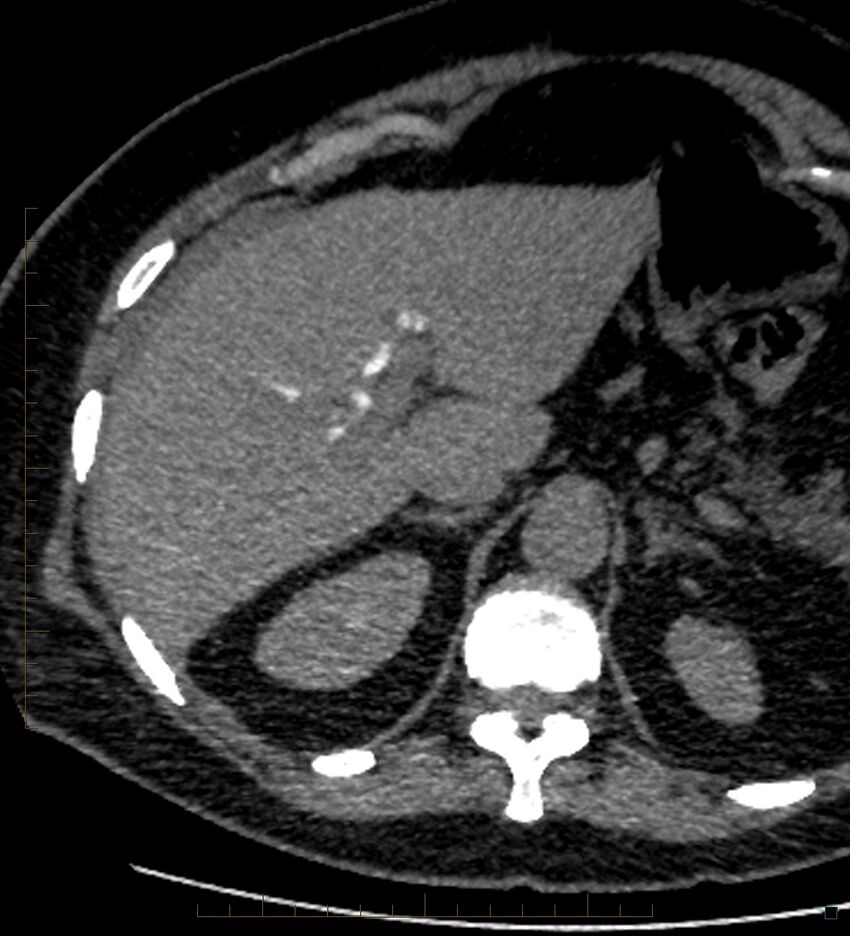 Bile leak from accessory duct(s) of Luschka post cholecystectomy (Radiopaedia 40736-43389 A 19).jpg