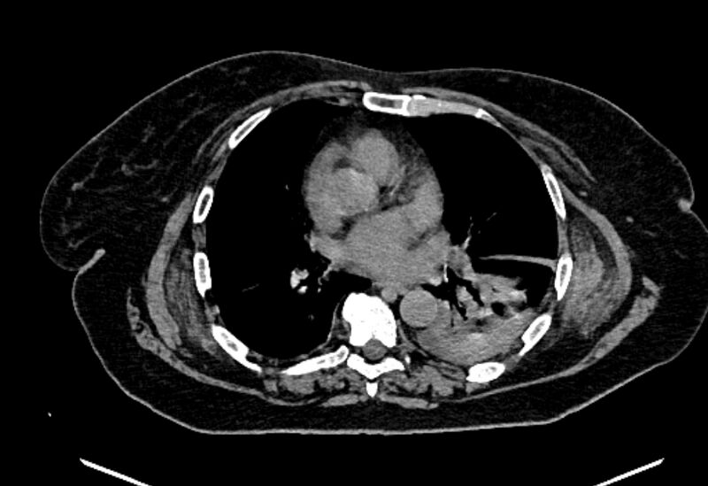 File:Biliary pancreatitis (Radiopaedia 72289-82823 Axial non-contrast 3).jpg