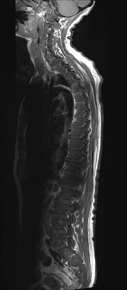 File:Bing-Neel syndrome (Radiopaedia 71453-81799 Sagittal T1 12).jpg