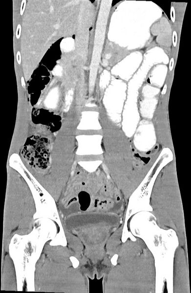 File:Blunt injury to the small bowel (Radiopaedia 74953-85987 B 52).jpg