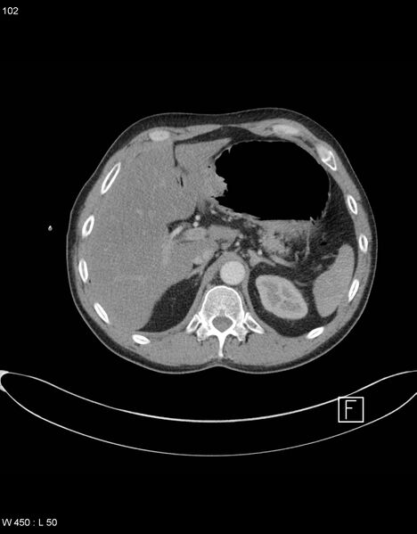 File:Boerhaave syndrome with tension pneumothorax (Radiopaedia 56794-63605 A 50).jpg