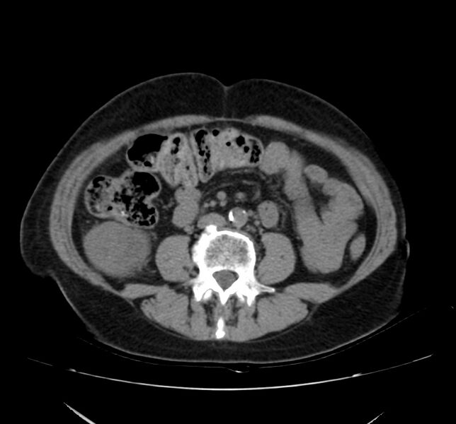 File:Bosniak renal cyst - type IV (Radiopaedia 22929-22953 Axial non-contrast 33).jpg