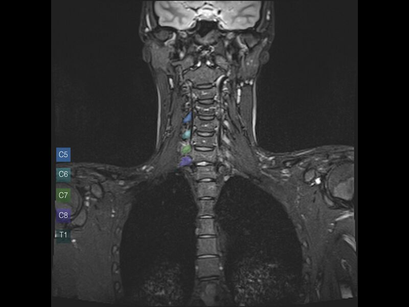 File:Brachial plexus anatomy (Radiopaedia 64414-73226 Coronal STIR 4).jpeg