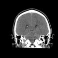 Brain death (Radiopaedia 78597-91360 Coronal non-contrast 49).jpg